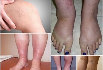 Mga litrato sa mga pagpakita sa varicose veins sa mga bitiis
