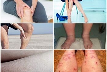 Mga simtomas sa varicose veins sa mga bitiis