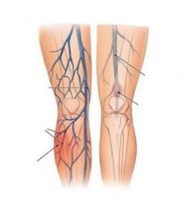 ang venous thrombosis nanginahanglan operasyon