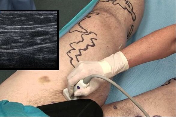 diagnosis sa varicose veins sa mga lalaki