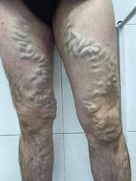gipasagdan nga lalaki nga varicose veins
