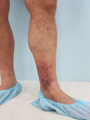 komplikasyon gikan sa varicose veins sa mga lalaki