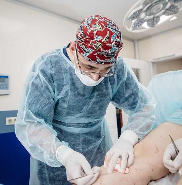 surgical pagtambal sa varicose veins