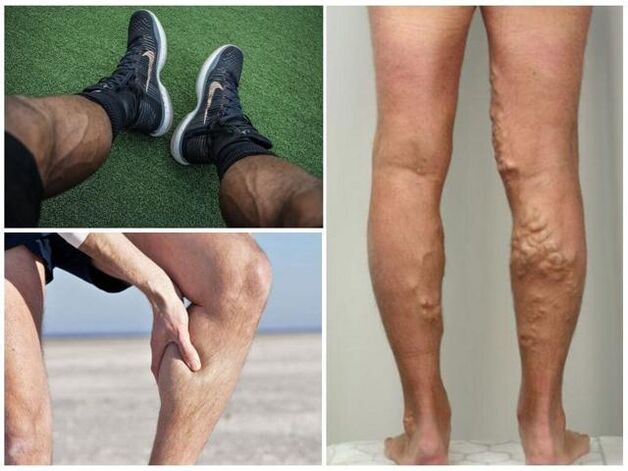 unsa ang hitsura sa varicose veins sa mga bitiis sa mga lalaki