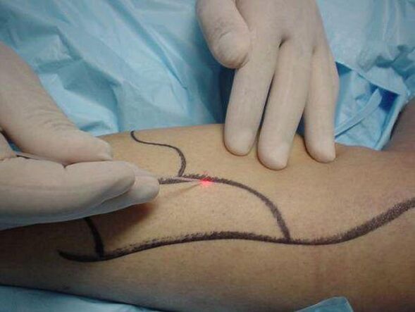 laser pagtambal sa varicose veins