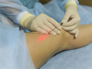 Pagtambal sa varicose veins sa laser