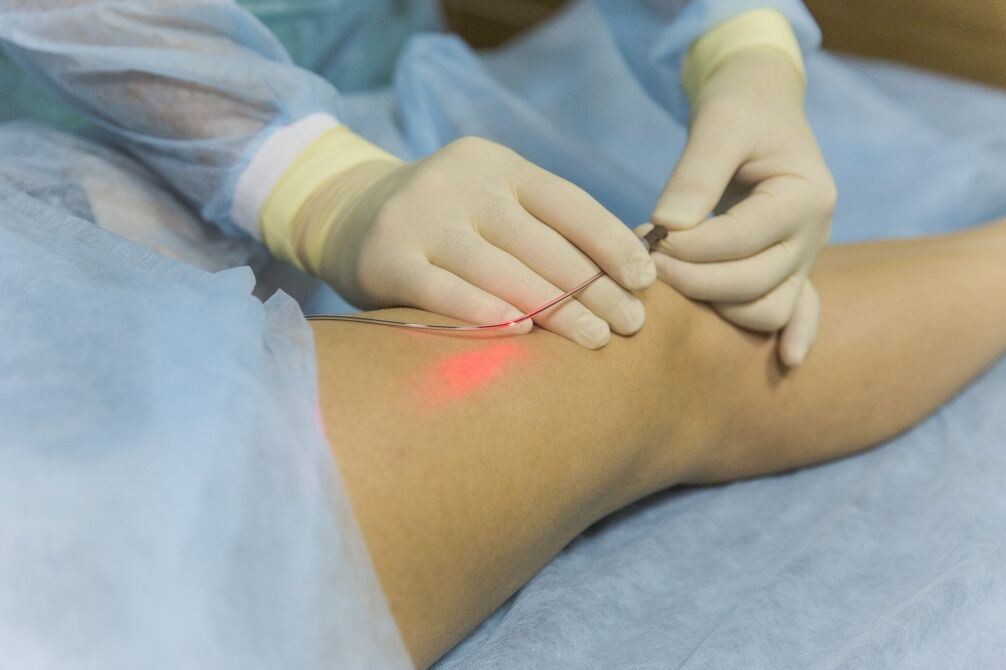 Laser pagtambal sa varicose veins sa ubos-ubos extremities