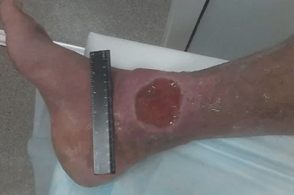 Mga komplikasyon sa Varicose Veins
