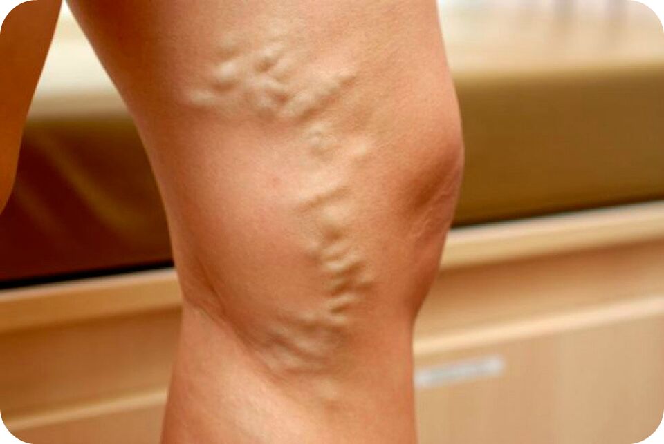 Varicose veins sa mga ugat