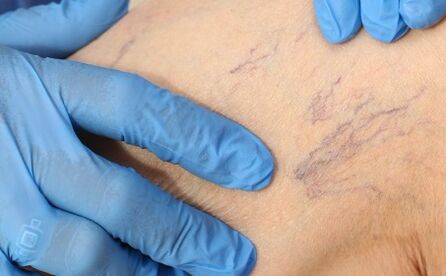 Mga Sintomas sa Varicose Veins
