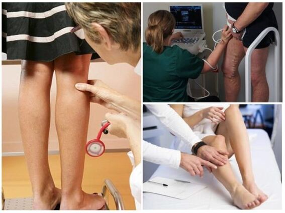 Diagnosis sa varicose veins