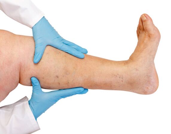 Varicose veins sa mga bitiis