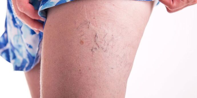 Paglikay sa mga varicose veins