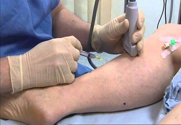 Pagtambal sa mga varicose veins