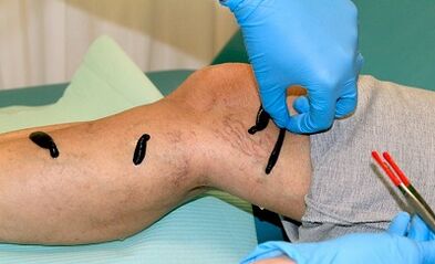Hirudotherapy alang sa varicose veins