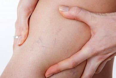 gidili nga mga aksyon alang sa varicose veins