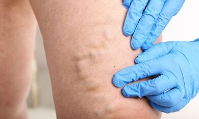 Varicose veins sa mga bitiis