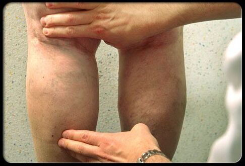 Gisusi sa doktor ang mga bitiis nga adunay varicose veins