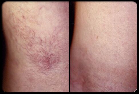 Sa wala pa ug pagkahuman sa sclerotherapy