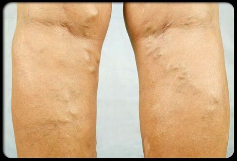 Varicose veins sa mga bitiis