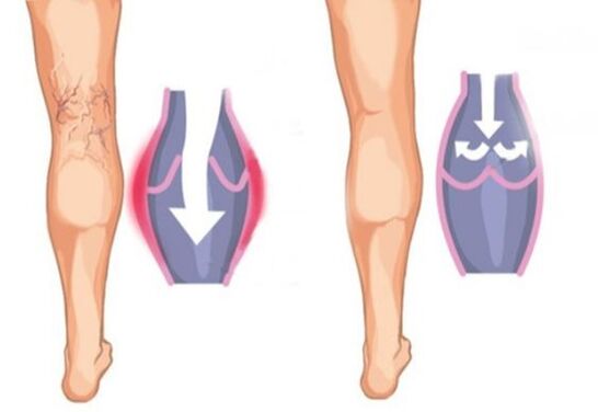 Kung unsa ang hitsura sa varicose veins
