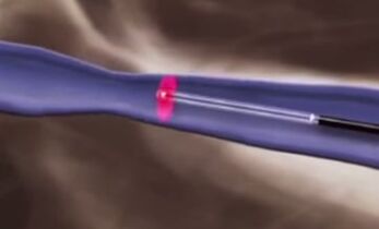 Mga thermal treatment