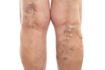 varicose veins sa ubos-ubos extremities